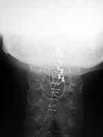 Dorsal column stimulator in cervical spine